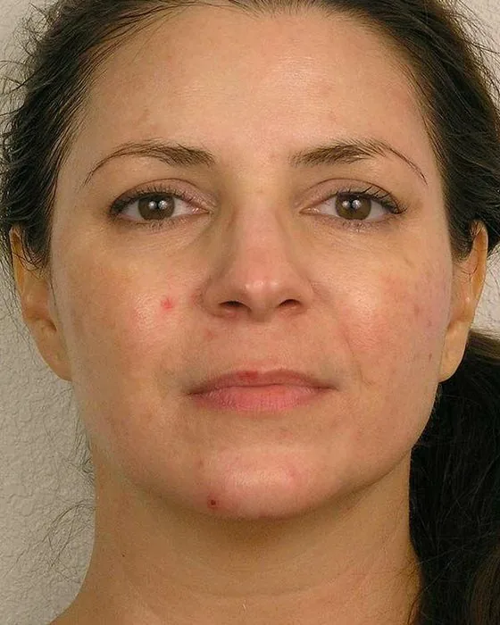 Before microcurrent treatment at Royal Skincare Scottsdale