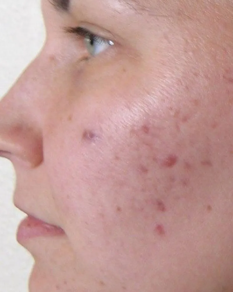 Before led light therapy treatment at Royal Skincare Scottsdale